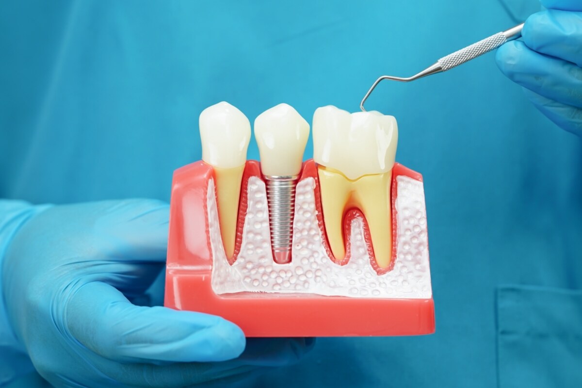dental implant restorations a permanent solution to tooth loss