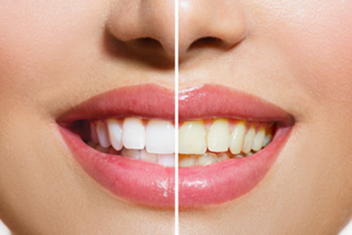 can yellow teeth be white again